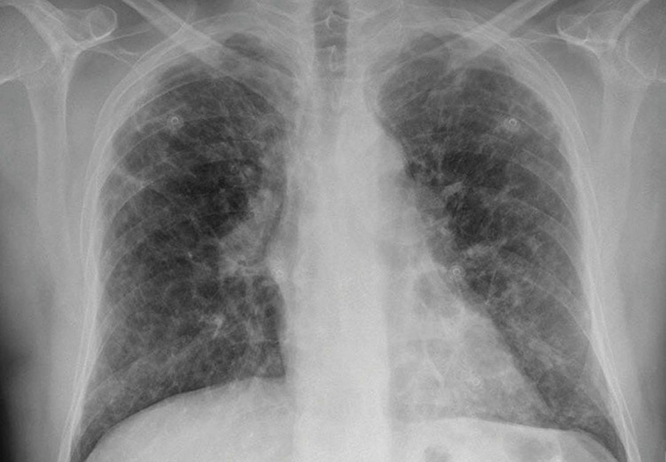 Patiënt met silicose